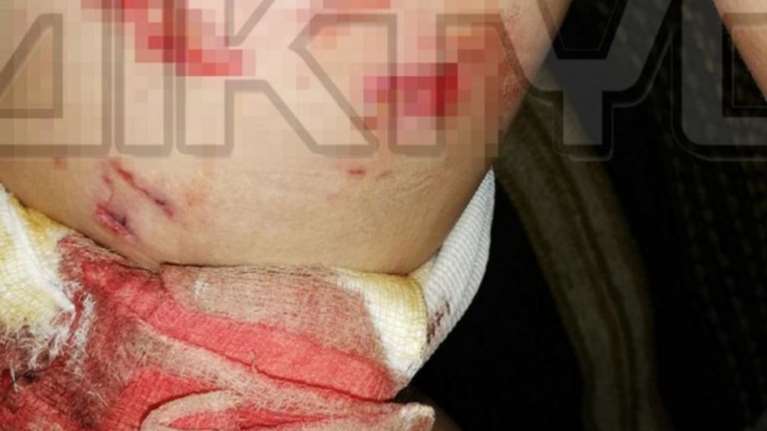 Αγρια επίθεση σκύλου σε παιδί στις Σέρρες - Πώς το έσωσαν