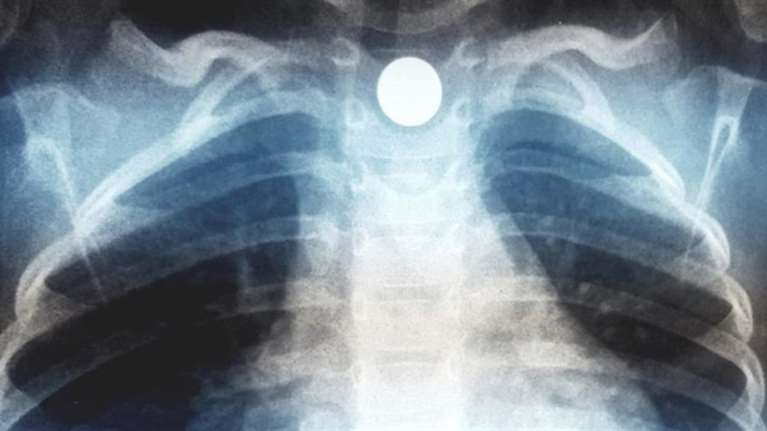 “Συναγερμός” για παιδί που κατάπιε μαγνητάκι ψυγείου