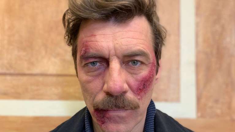 Ο Γιάννης Στάνκογλου δείχνει πώς έγινε μετά το ξύλο στις «Αγριες Μέλισσες»