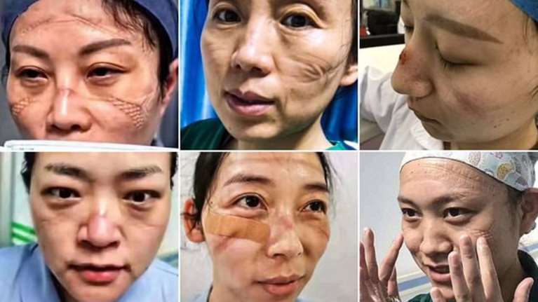 Κοροναϊός: Εικόνες - σοκ από τα πρόσωπα γιατρών στην Ουχάν