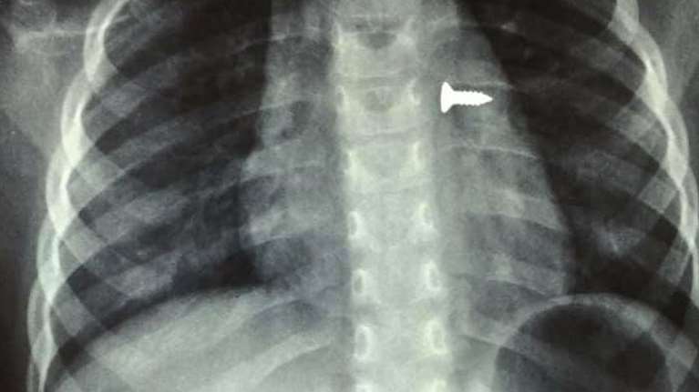 Σοκ στην Κρήτη: 3χρονη κατάπιε βίδα και κατέληξε στον πνεύμονά της [εικόνες]