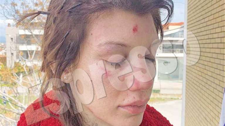 Εφιαλτική επίθεση στη Μαρία Αλεξάνδρου: Έξι γυναίκες την απήγαγαν, την χτύπησαν και την κούρεψαν [εικόνες]