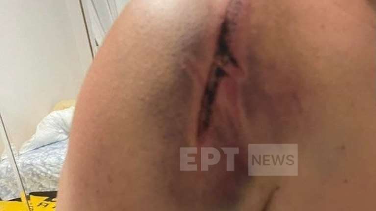 &quot;Με χτυπούσαν στο κεφάλι και το σώμα&quot;: Σε σοκ ο οδηγός λεωφορείου που έπεσε θύμα ξυλοδαρμού από επιβάτες στη Θεσσαλονίκη