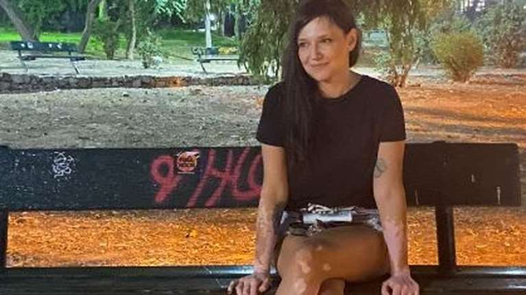 Αθηναΐδα Νέγκα: Το αισχρό σχόλιο για τη λεύκη στα πόδια και η απάντησή της