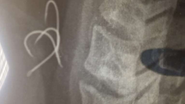 Αφαιρέθηκαν τα αγκίστρια από τον 38χρονο από το Αγρίνιο - Τα κατάπιε τρώγοντας χταπόδι: &quot;Μου κόπηκε η ανάσα&quot;