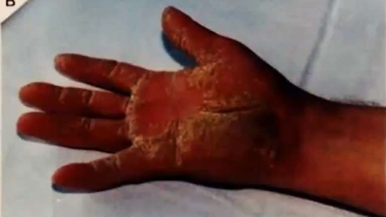 Τα δύο χαρακτηριστικά γνωρίσματα που δείχνουν ότι κάποιος μπορεί να έχει τη νόσο της Νάξου