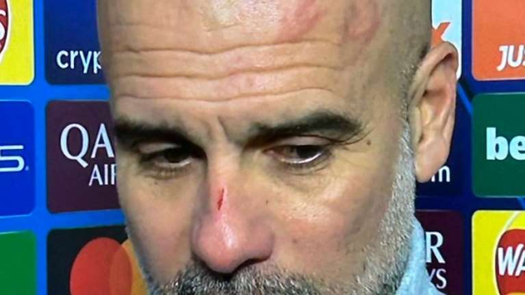 Χαμός στα social media για τις γρατζουνιές στο πρόσωπο του Γκουαρδιόλα - Η εξήγηση του ίδιου και οι φήμες για επεισόδια