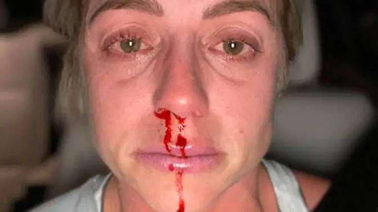 Σοκ - Γυναίκες δείχνουν το μελανιασμένο πρόσωπό τους από την κακοποίηση στην καραντίνα του κορονοϊού [εικόνες]