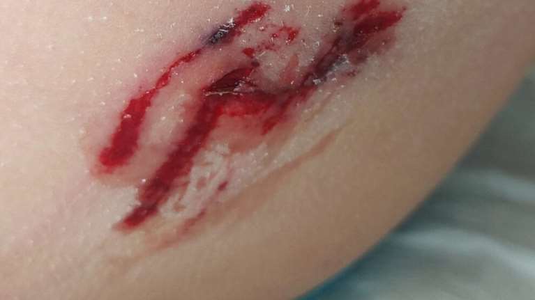 Καστοριά: Αδέσποτο σκυλί επιτέθηκε και δάγκωσε δύο οκτάχρονα παιδιά - Μεταφέρθηκαν στο νοσοκομείο