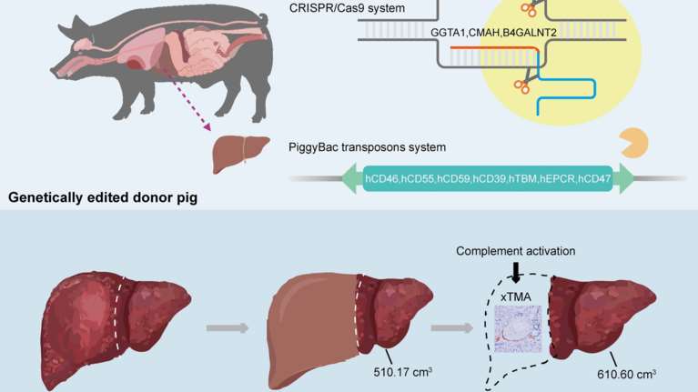Η πρώτη στον κόσμο μεταμόσχευση ήπατος από χοίρο σε άνθρωπο - Ο ασθενής επέζησε για 171 ημέρες