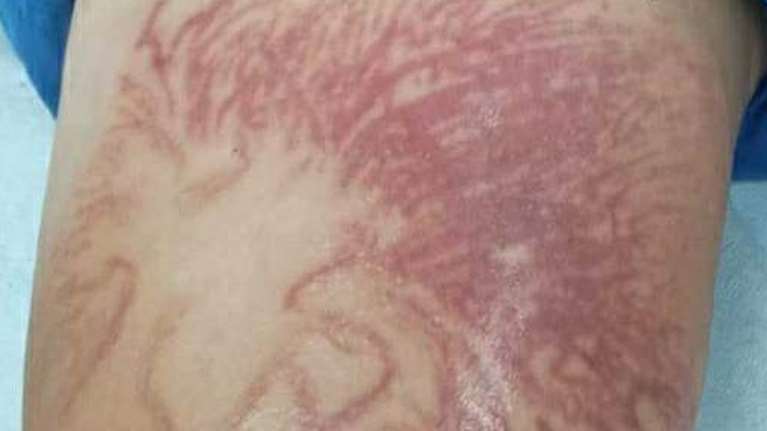 Κορινθία: Στο νοσοκομείο 9χρονος μετά από τσίμπημα θαλάσσιας ανεμώνης - Σκληρές εικόνες