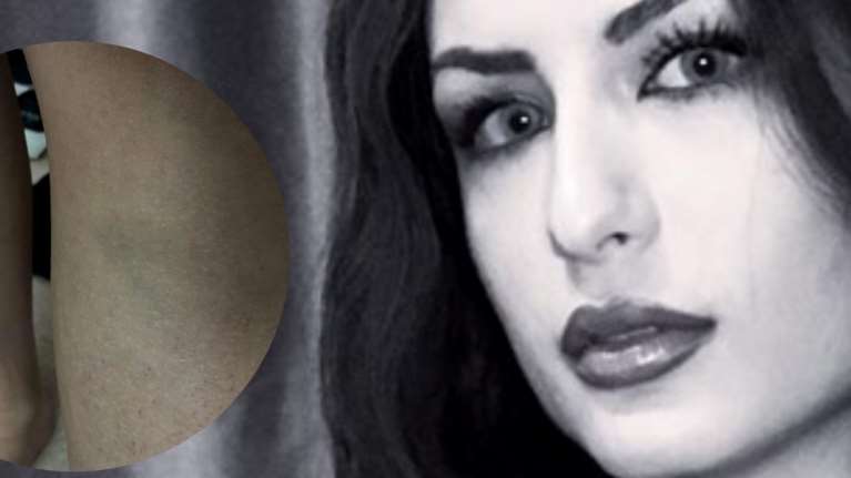 Βιασμός 24χρονης στη Θεσσαλονίκη: Φωτογραφίες σοκ με τους μώλωπες στο σώμα της Γεωργίας