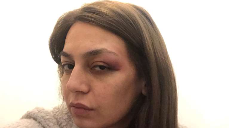 Πέραμα: Τα ΜΑΤ χτύπησαν βουλευτίνα του ΜέΡΑ25 - Στο νοσοκομείο με πρησμένο μάτι [εικόνα]