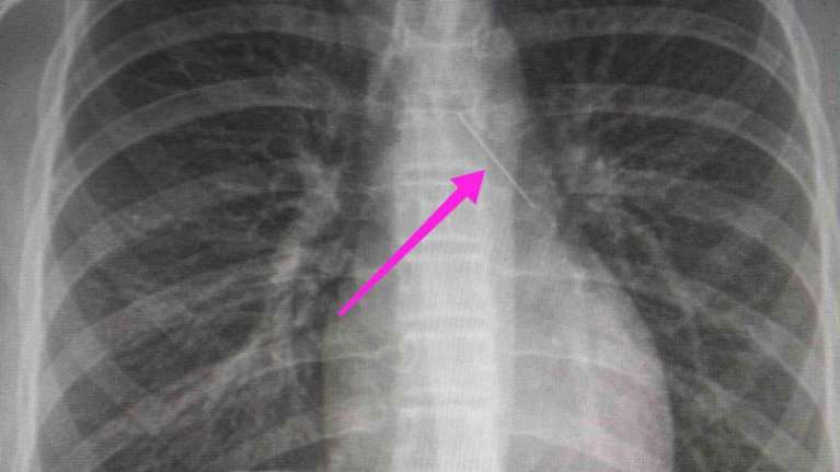 Θεσσαλονίκη: Ανήλικη κατάπιε καρφίτσα- Βρέθηκε &quot;σφηνωμένη&quot;  στον δεξιό κύριο βρόγχο
