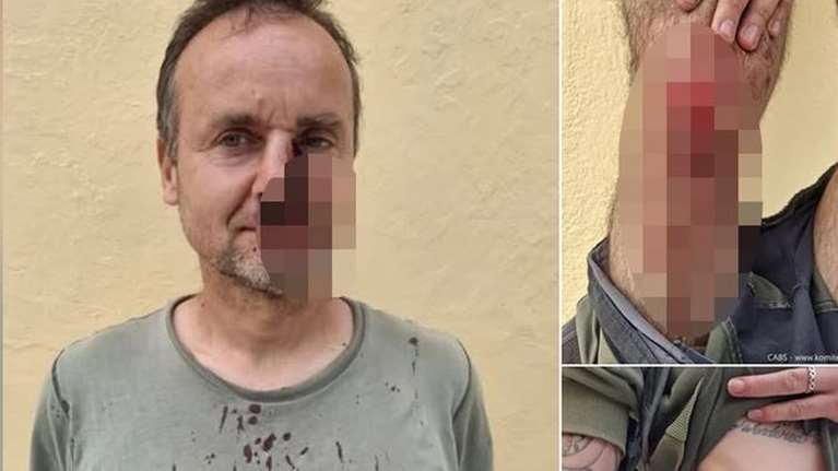 Ζάκυνθος: Άγριο ξύλο λαθροκυνηγών σε ορνιθολόγους- Τους έστειλαν στο νοσοκομείο με βαριά τραύματα