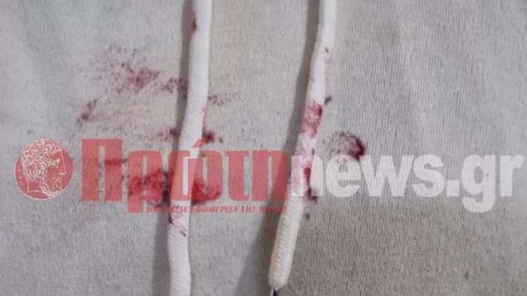 Ηλεία: Χτύπησε άγρια την 13χρονη κόρη του και την έστειλε στο χειρουργείο - Με αίματα η μπλούζα της