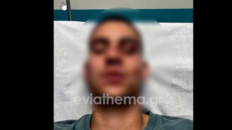 "Μιλάμε για απόπειρα ανθρωποκτονίας" - Τι αποκαλύπτει ο πατέρας του 19χρονου που ξυλοκοπήθηκε στη Χαλκίδα για ένα like