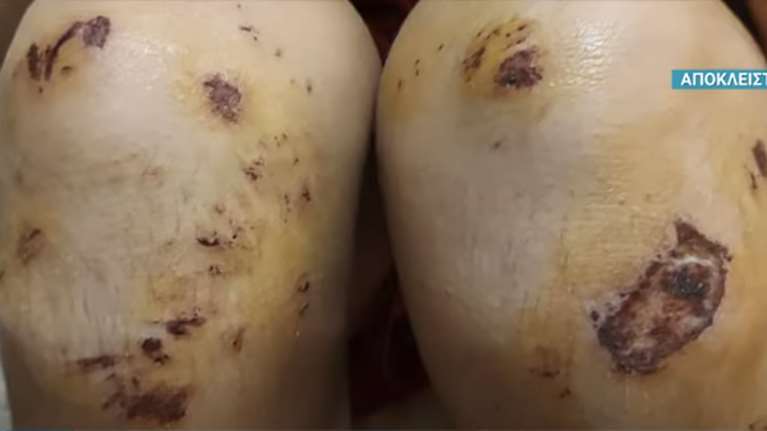 Θεσσαλονίκη: Θύμα οπαδικής βίας 14χρονος - Από τα χτυπήματα υπέστη αιμάτωμα στο συκώτι [βίντεο]