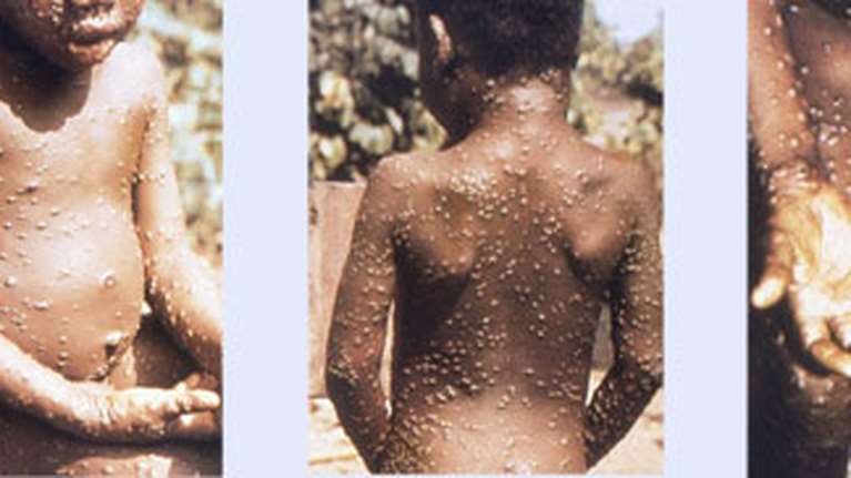 Μπορεί η ευλογιά των πιθήκων να εξελιχθεί σε νέα πανδημία; - 10+1 ερωτήσεις &amp; απαντήσεις για όσα γνωρίζουμε έως τώρα