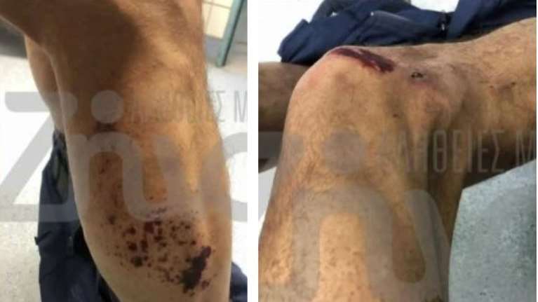 Τέμπη: Φωτογραφίες από τα χημικά εγκαύματα πυροσβεστών - &quot;Έβγαλα το γάντι και είδα το χέρι άσπρο, είχε νεκρώσει ο ιστός&quot;