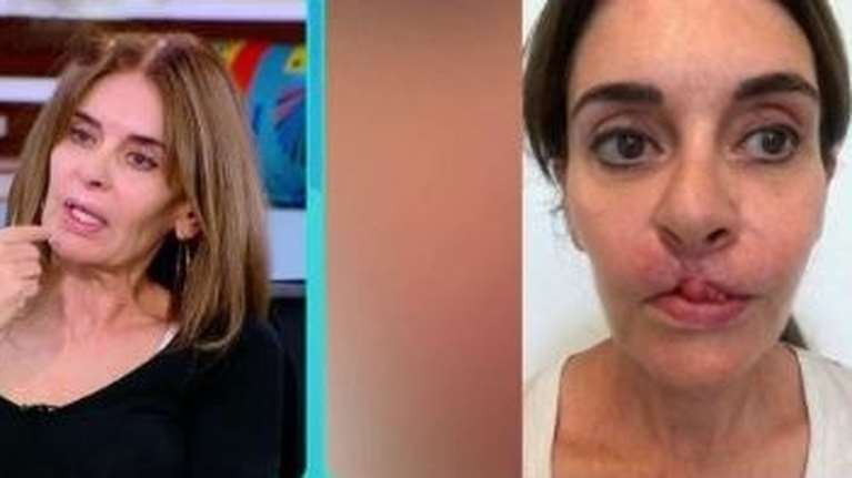 Συγκλονίζει η Κατερίνα Πλουμιδάκη: &quot;Στις 40 εγχειρήσεις θα είμαι καλύτερα&quot; - Όσα αποκάλυψε η συγγραφέας για τις επεμβάσεις στα χείλη