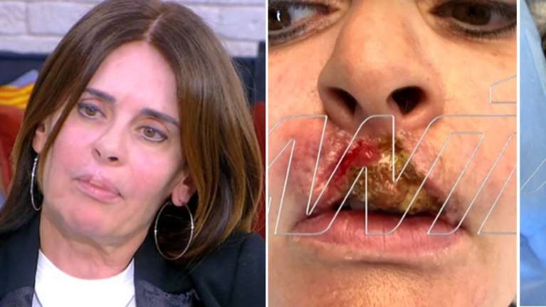 Κατερίνα Πλουμιδάκη: Τα χείλη της νέκρωσαν και σάπισαν από αποτυχημένη επέμβαση Ελληνα πλαστικού χειρουργού [Βίντεο]