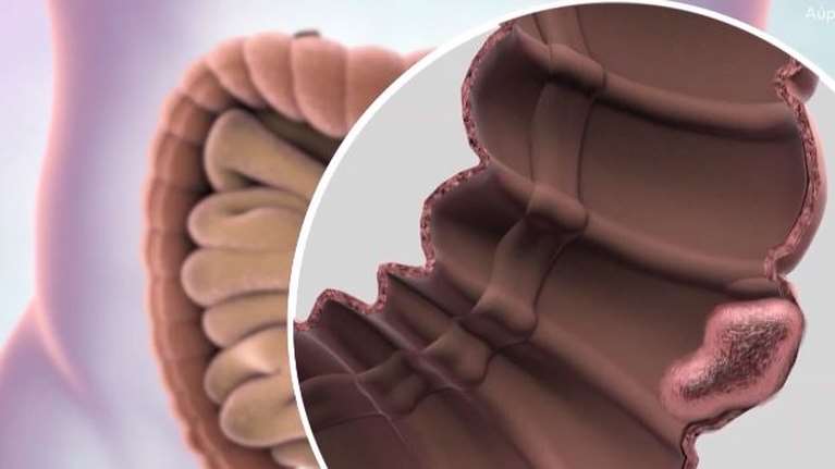 Ελπίδες από κλινικές δοκιμές στη Νέα Υόρκη: Φάρμακο &quot;εξαφάνισε&quot; τον καρκίνο του παχέος εντέρου [Βίντεο]