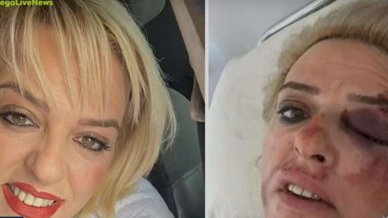 Καλαμάτα: "Δεν είπα ποτέ ότι με δάγκωσαν τα σκυλιά, αλλά η κατάσταση είναι ανεξέλεγκτη", λέει η 45χρονη [Βίντεο]