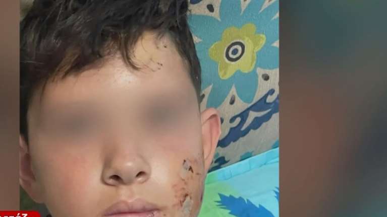 Λαγονήσι: Σκύλος επιτέθηκε άγρια σε 13χρονο που πήγαινε στο σχολείο - &quot;Θα τον σκότωνε&quot;, λέει η μητέρα