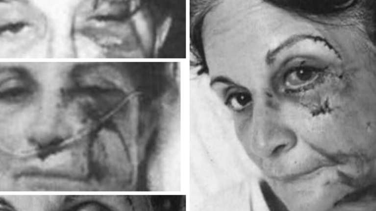 Συμβόλαιο ξυλοδαρμού στην Αίγινα: Φωτογραφίες σοκ από τα άγρια χτυπήματα με σιδερογροθιές στην επιχειρηματία