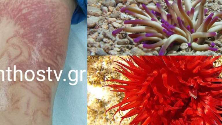 Θαλάσσια ανεμώνη: Το επικίνδυνο σαρκοφάγο ζώο που τσίμπησε τον 9χρονο στην Κορινθία - Πώς θα την αναγνωρίσετε