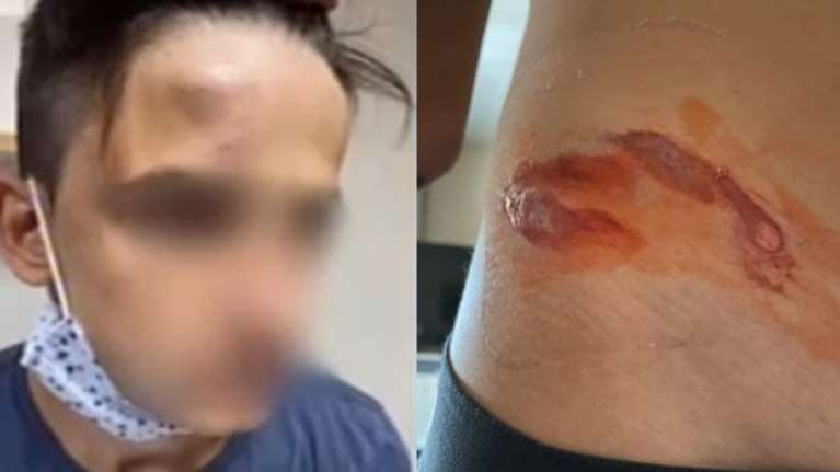 Συγκλονίζει ο 17χρονος μετά τον ξυλοδαρμό σοκ: &quot;Είχα παντού αίματα, μώλωπες, καρούμπαλα - Θα χρειαστώ χειρουργείο στη γνάθο&quot;