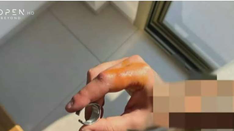 Χαλκιδική: Γιατροί έψαχναν στο Youtube για να αφαιρέσουν δαχτυλίδι από χέρι ασθενούς - Τελικά φώναξαν... ηλεκτρολόγο με τροχό
