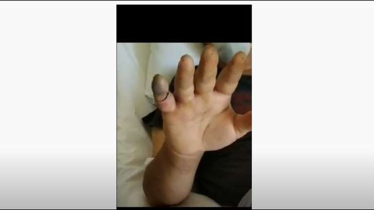 Λάρισα: Ανατριχιαστικές εικόνες από χέρι άντρα που δάγκωσε οχιά [Βίντεο]