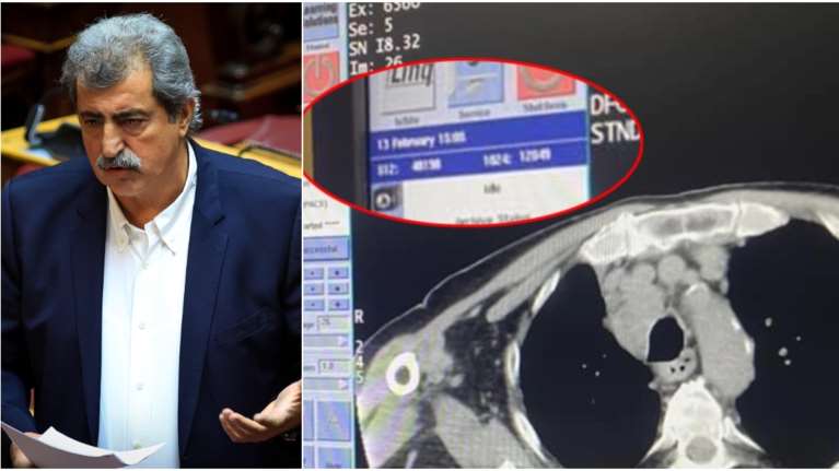Είχε χειρουργείο ή όχι τελικά ο Παύλος Πολάκης; - Τι απαντά για τις φωτογραφίες με ημερομηνία 13 Φεβρουαρίου που ανέβασε