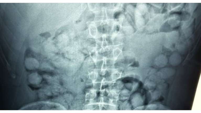 &quot;Ελ. Βενιζέλος&quot;: Συνελήφθη Βραζιλιάνος που είχε καταπιεί 100 &quot;αυγουλάκια&quot; κοκαΐνης