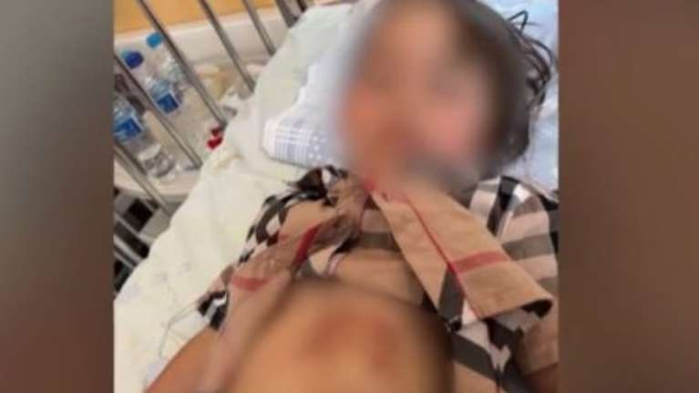 Χαλκιδική: Σοκάρουν τα τραύματα της 5χρονης που δέχθηκε επίθεση από λύκο σε παραλία [εικόνες]