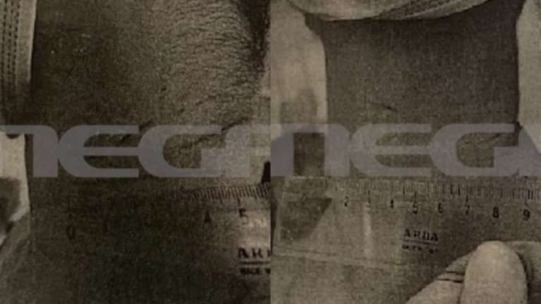 Αρσάκειο: Φωτογραφίες με τα σημάδια από την πετονιά - Μήνυση για απόπειρα ανθρωποκτονίας από την οικογένεια του 15χρονου