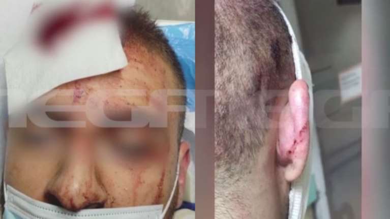 Ατύχημα στο Allou Fun Park: Φωτογραφίες σοκ από τα τραύματα στο κεφάλι του 25χρονου - &quot;Δεν ήμασταν όρθιοι&quot; [Εικόνες - Βίντεο]