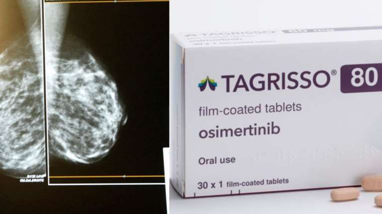 Σπουδαία ανακάλυψη: Το χάπι που μειώνει κατά 50% μια συγκεκριμένη μορφή καρκίνου στον πνεύμονα