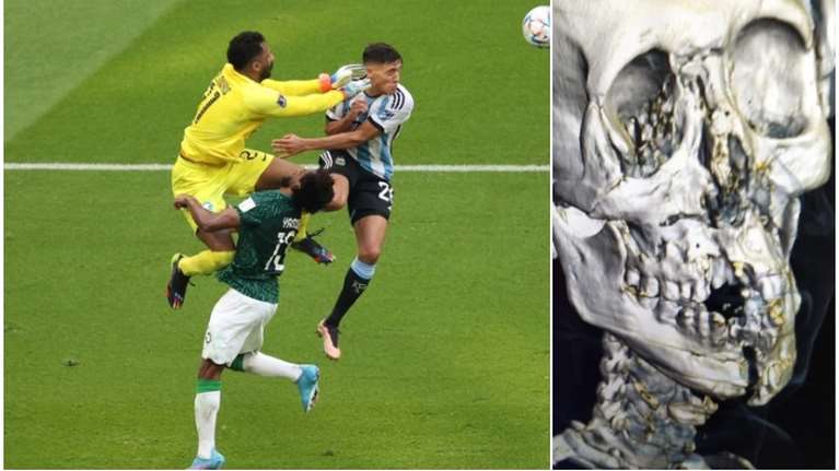 Μουντιάλ 2022: Σοκάρει η ακτινογραφία του Αλ Σαχρανί- Η σύγκρουση του μπακ της Σαουδικής Αραβίας με τον τερματοφύλακα [εικόνες]