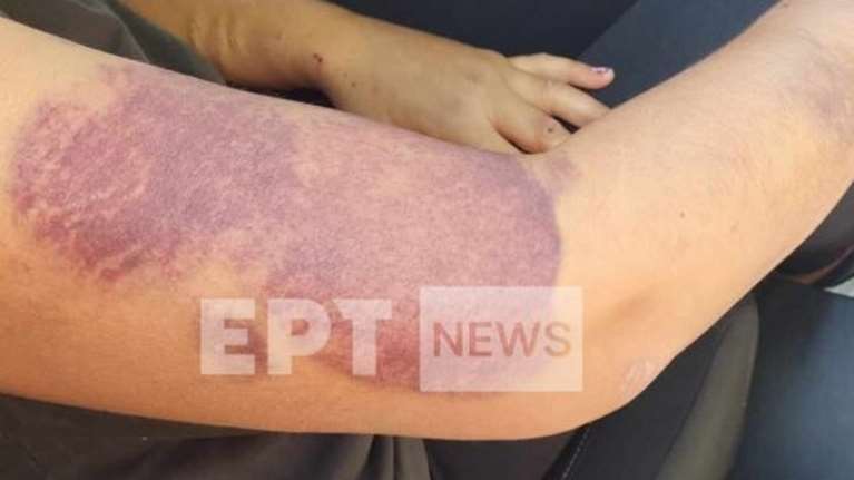 Διδυμότειχο: Τρομοκρατημένη και συνοδευόμενη από άνδρες της ασφάλειας πήρε εξιτήριο η 32χρονη - Αναζητείται ο σύντροφός της