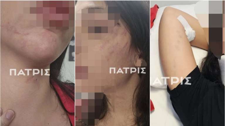 Έδεσσα: 29χρονη έζησε εφιαλτικό τριήμερο από τον σύντροφό της - Την ξυλοκόπησε βάναυσα και την πέταξε στον δρόμο από το αμάξι