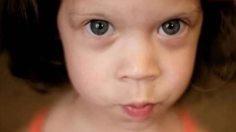 Τι είναι το σύνδρομο Williams από το οποίο πάσχει ο εγγονός της Κορίνας Τσοπέη - Τα χαρακτηριστικά, η πρόληψη και η θεραπεία