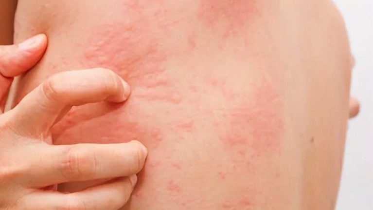 Μετάλλαξη Όμικρον: Αυτά είναι τα δερματικά συμπτώματα που προκαλεί - Πόσοι τα εμφανίζουν [Βίντεο]
