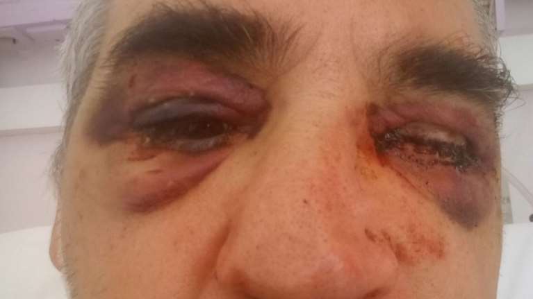 Μύκονος: Σε κακούργημα αναβαθμίζεται η μαφιόζικη επίθεση εναντίον του αρχαιολόγου