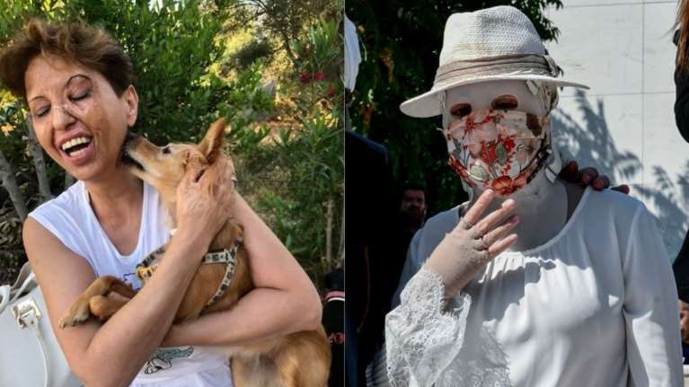 Μήνυμα ελπίδας για την Ιωάννα Παλιοσπύρου: Η ιστορία της Καλλιόπης, που κάηκε σε ηλικία 4 ετών αλλά δεν το έβαλε κάτω