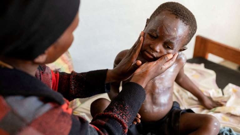 Νόσος Mpox: Το νέο στέλεχος προκαλεί ανησυχία στους επιστήμονες - &quot;Στην Αφρική δουλεύουμε στα τυφλά&quot;