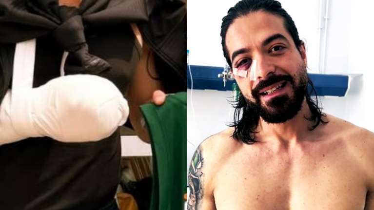 Άρης Μουγκοπέτρος: Η πρώτη φωτογραφία με το τραυματισμένο χέρι του [εικόνα]