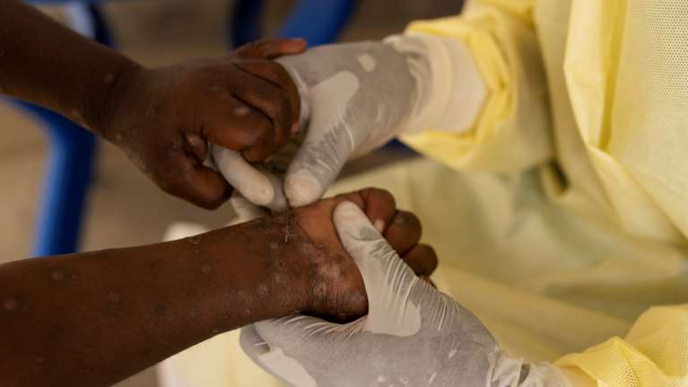 Ευλογιά των πιθήκων: Παγκόσμια ανησυχία για την έξαρση των κρουσμάτων - Πώς μεταδίδεται, ποιες ομάδες κινδυνεύουν περισσότερο